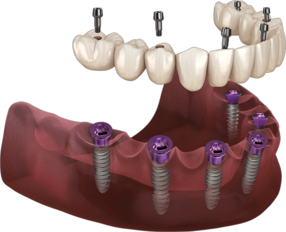 A full-arch bridge lifted off its implants, with the prosthetic screws above it.