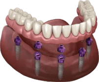 Overdenture